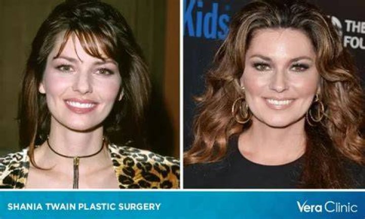 Did Shania Twain Undergo Plastic Surgery? Shania Twain Plastic Surgery